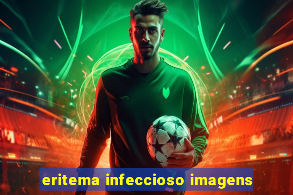 eritema infeccioso imagens